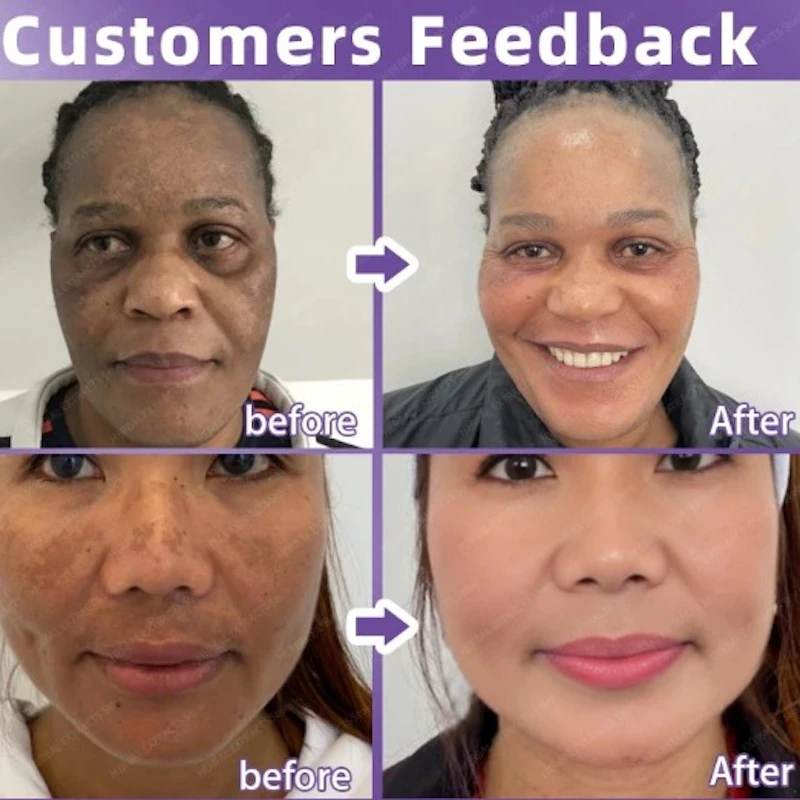 ZOO·SON® ANTI FRECKLE WHITENING PURPLE  CREAM